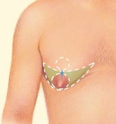 Gynecomastia Surgery incision spot