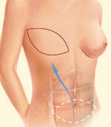 Breast Reduction Surgery | East Brunswick, NJ