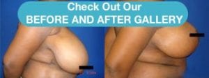Breast Lift Before and After East Brunswick, NJ and Staten Island, NY
