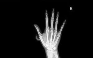 Xray image of a patient with polydactyly who has extra nonfuntional digit with bones and joint